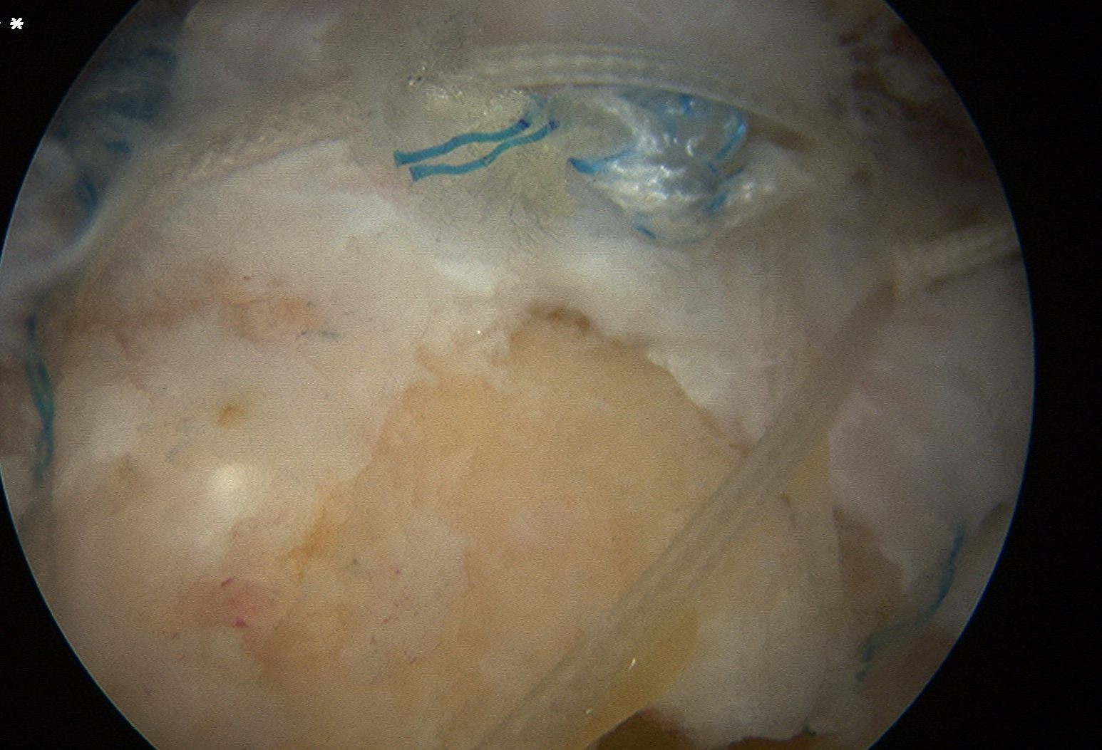 Arthroscopic Cuff Suture Bridge Repair